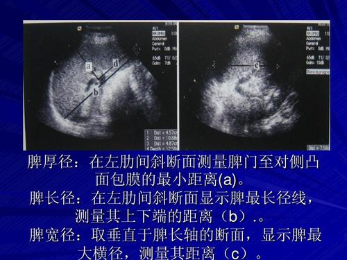 脾长径:在左肋间斜断面显示脾最长径线, 测量其上下端的距离(b).