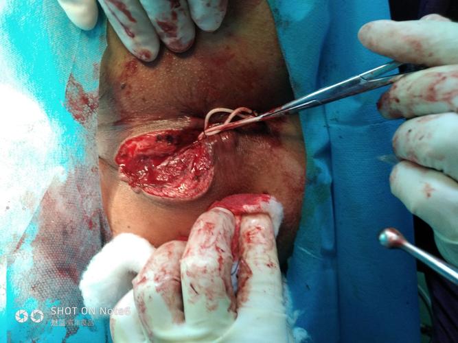 肛瘘切开挂线术