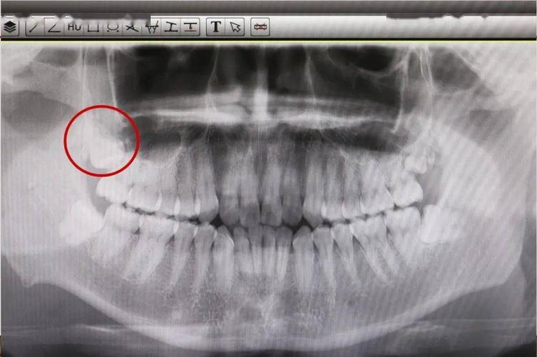 高清图示右侧上颌高位阻生牙拔除一例