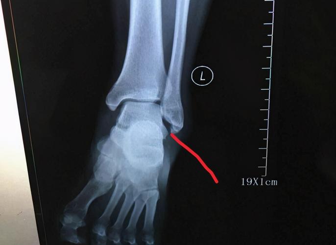 外踝扭伤了,肯定要拍个踝关节正侧位片,看看有没有腓骨下端的骨折