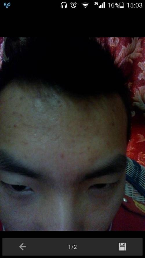 额头上有很多痘印(不知道是不是),扣下来就是白色的小