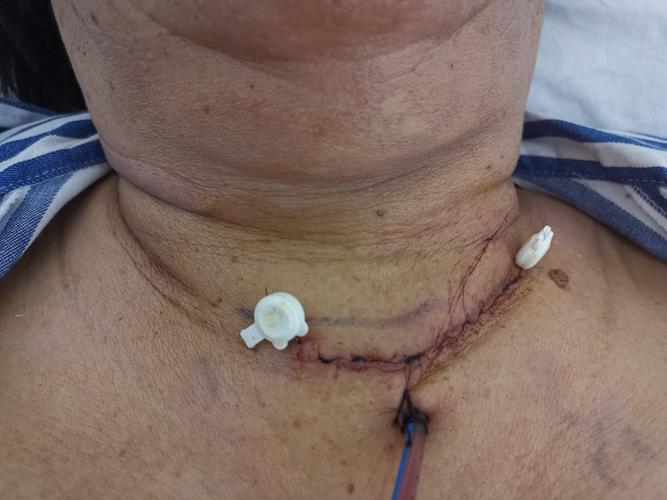 精益求精!海医二附院首例胸锁乳突肌间隙入路行甲状腺肿瘤手术