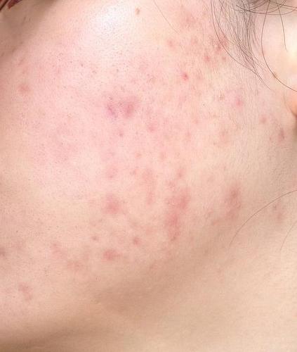 因为痘痘一切都变了.[有图慎入]