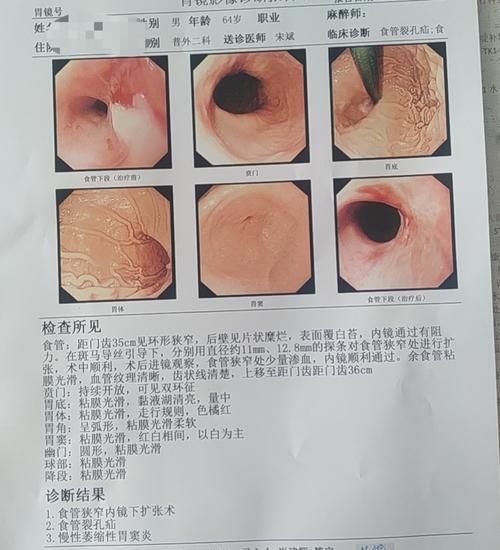 胃食管反流远期危害:食管狭窄食管裂孔疝合并食管狭窄如何治疗