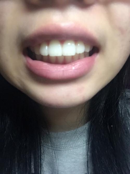 以下原回答从小我的牙齿就是整齐但是龅牙,后来…  显示全部