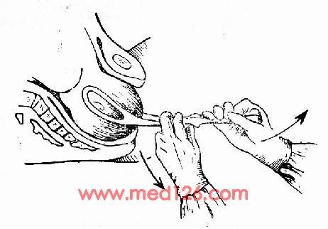 产钳术的注意事项