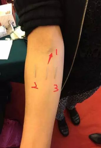 乳腺增生的灵枢针灸疗法