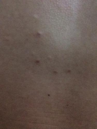 胸口皮肤粒状 有凹凸感 不可推动 好几年了一直没理 这段时间又冒出了