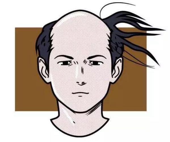 脂溢性脱发,养血生发胶?