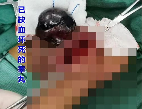 临泉俩未成年睾丸惨遭切除!就因为家长.