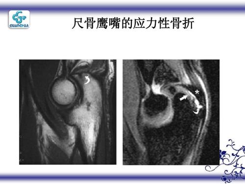 尺骨鹰嘴的应力性骨折