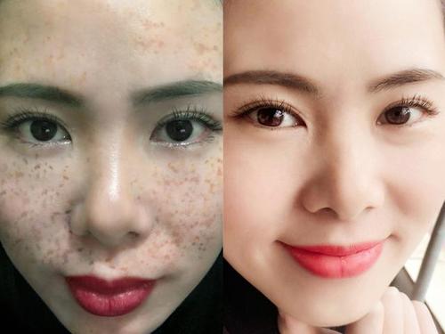 28岁宝妈一脸色斑很自卑,睡前抹两滴天然胶囊油,嫩白褪色斑自信满满