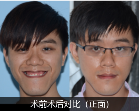 地包天严重脸型图片矫正后变化有多大?