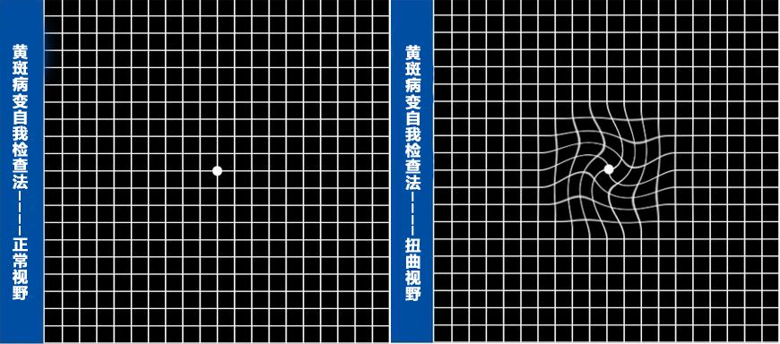 什么是黄斑病变?