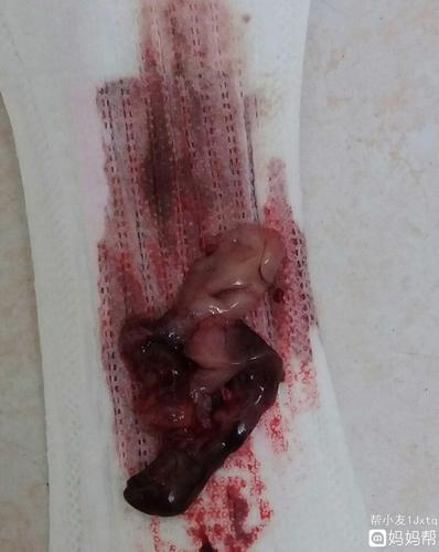 这是我吃完达英35,来月经排出来的有知道