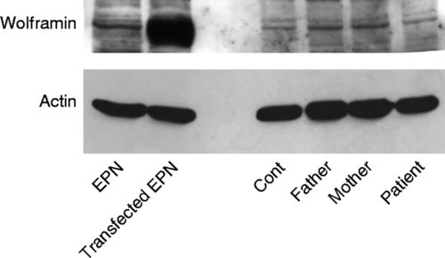 early-onset central diabetes insipidus is associated with