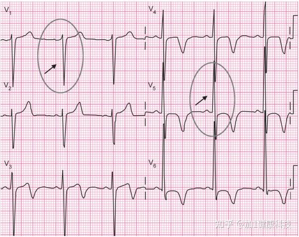 5分钟读懂心电图的9个步骤 【纯干货】