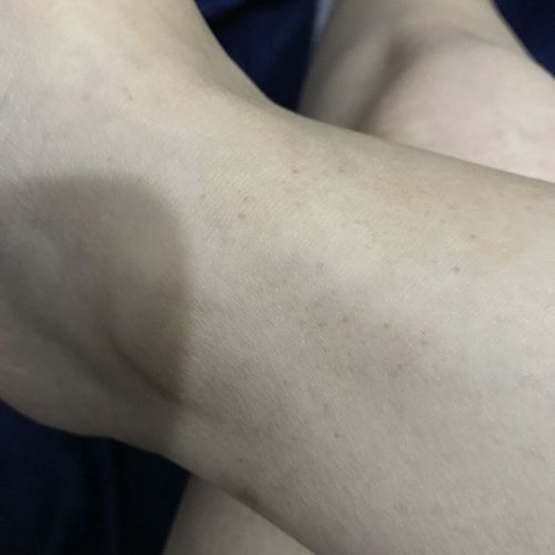 脚腕上有一点点出血点 是紫癜吗