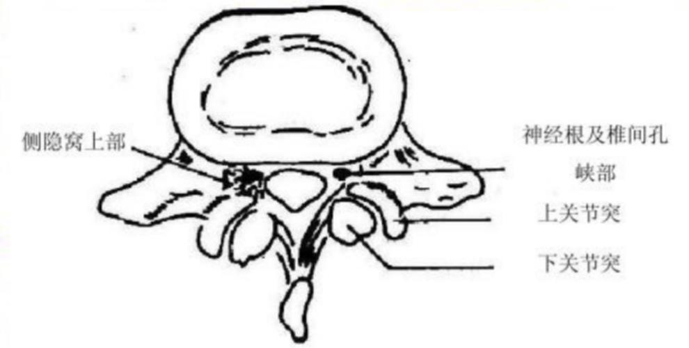 椎间盘膨隆突出,骨性退变导致的腰椎中央管,神经根管或侧隐窝狭窄引起