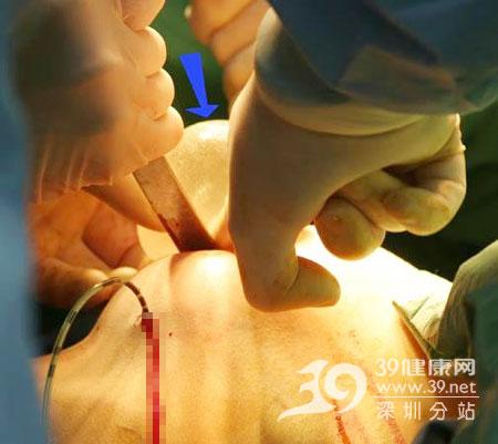 点点往里探,慢慢把原先粘在一起的两片肌肉分开,为假体的置入腾出空间