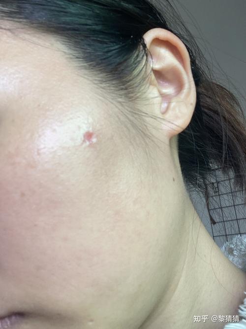 就是因为这样,这次等了好久都不掉痂,下图伤口是第九天.