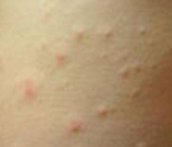 疥疮的早期症状