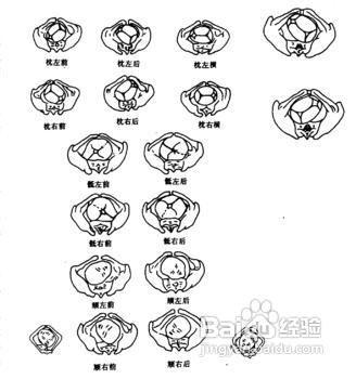 剖腹产的标准是怎样的?