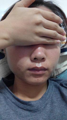 昨天跟朋友去海边,然后晒伤了皮肤,现在脸都红红的