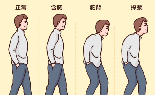 驼背跟个子高有关系?其实是含胸,怎么区分和矫正