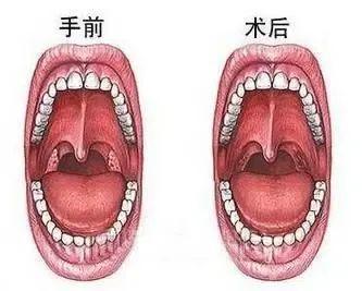 科普小儿腺样体肥大术后如何护理