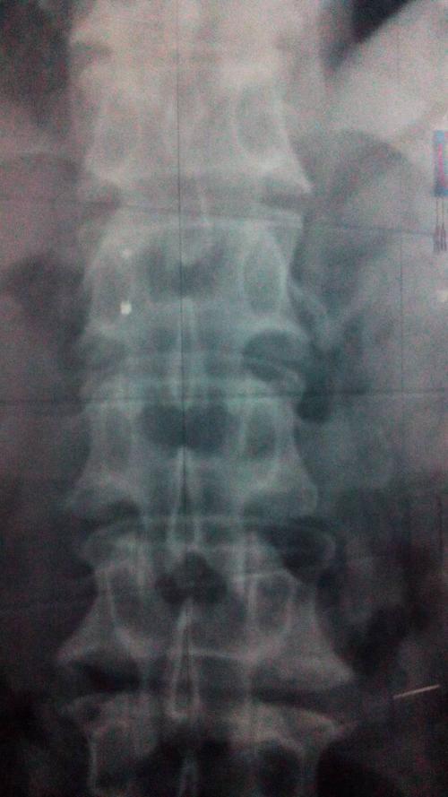 这个腰部ct(x射线)能看出来有什么毛病吗?腰非常疼!应该怎么治疗?