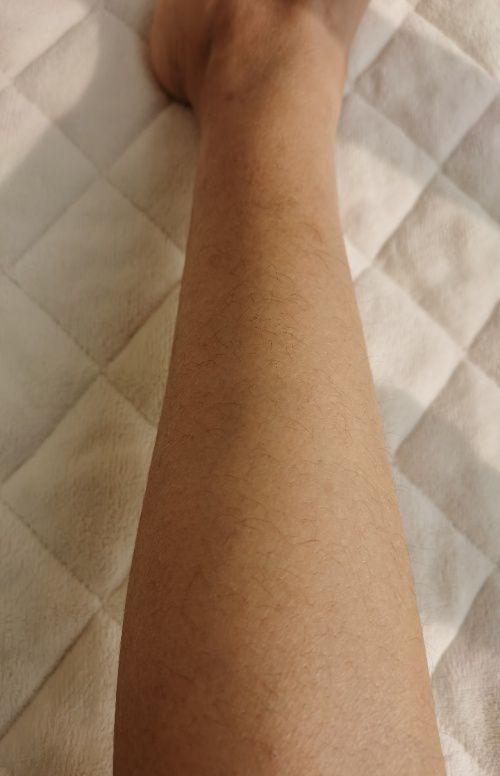 鱼鳞病一直不好其实就是你懒用好了甘油保证你的鱼鳞都游走