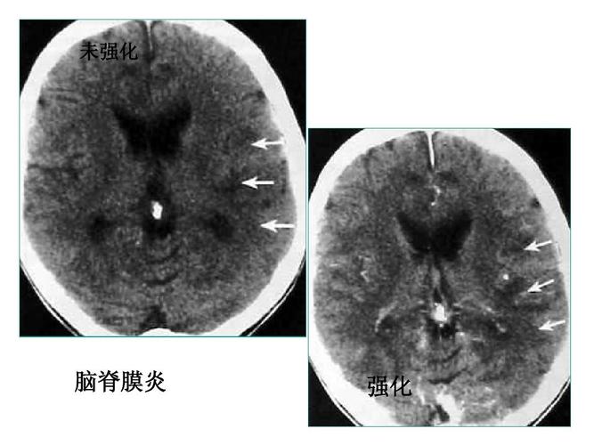 未强化 脑脊膜炎 强化
