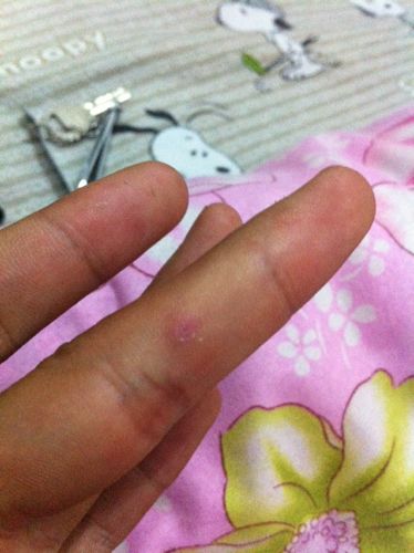 前不久手上长了个这个东西一按会疼我就