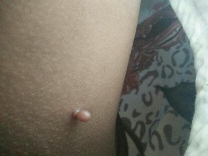 我这大腿内侧不知道起了个什么东西,已经有三年了,一开始像一块多出来