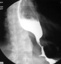 食管贲门失弛缓症