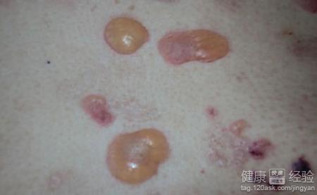 天疱疮有哪些症状