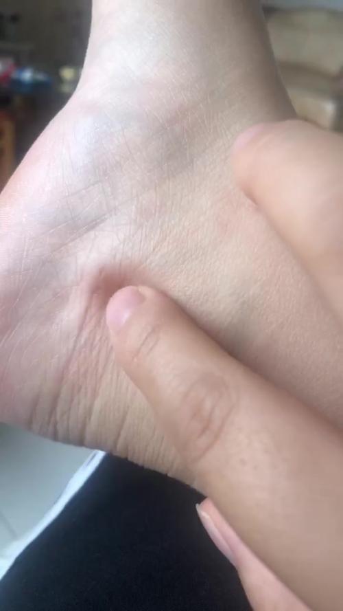 脚踝内侧有一个硬疙瘩?
