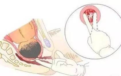 宫口到底开到几指最疼?产科医生这样说