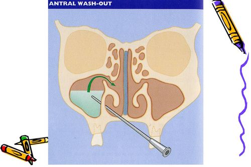 诊断 治疗 诊断 治疗 改善通气,引流 上颌窦穿刺冲洗 置换法