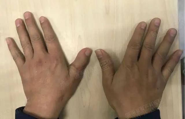 难道手指缺失就没办法了吗?有种方法能成功再造手指!