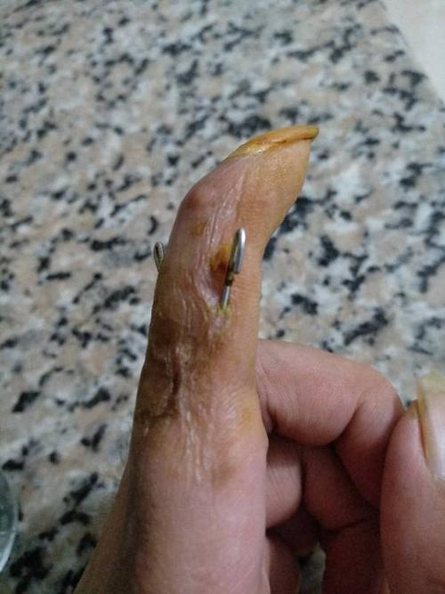 手指食指骨折手术三个月了,外露克氏针还拆不了