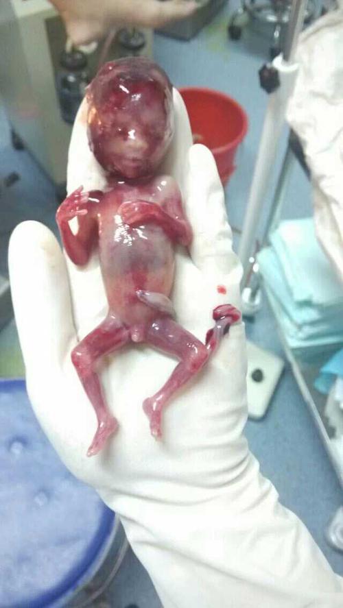 5个月胎停发育的宝宝有图慎入.