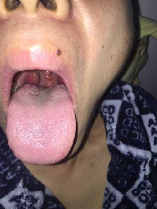 舌头根部起白色圆状的东西