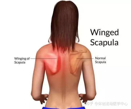 正常的肩胛骨应当紧贴胸壁,但肩胛骨并非胸壁的一部分,而是一块游离