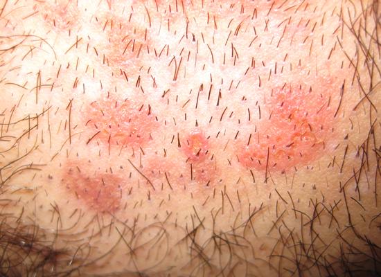 老中医谈 预防外阴湿疹的食疗方