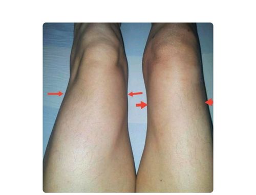 左大腿周径明显大于右侧提示右大腿肌肉萎缩