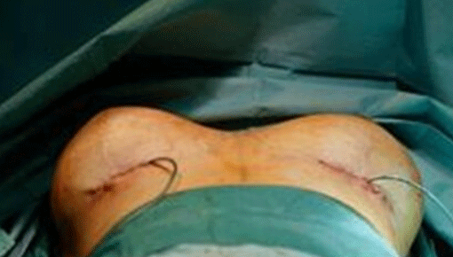 "胸部"移位险丧命 你还敢隆胸吗?