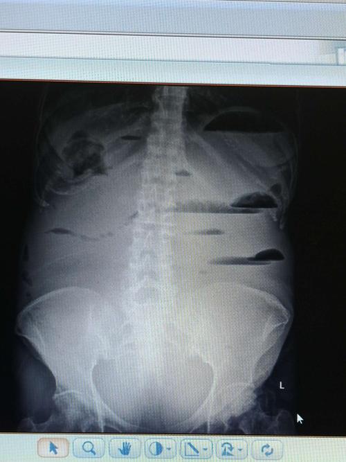 入院后行立位腹平片检查,提示腹腔可见气液平,于是对症治疗.