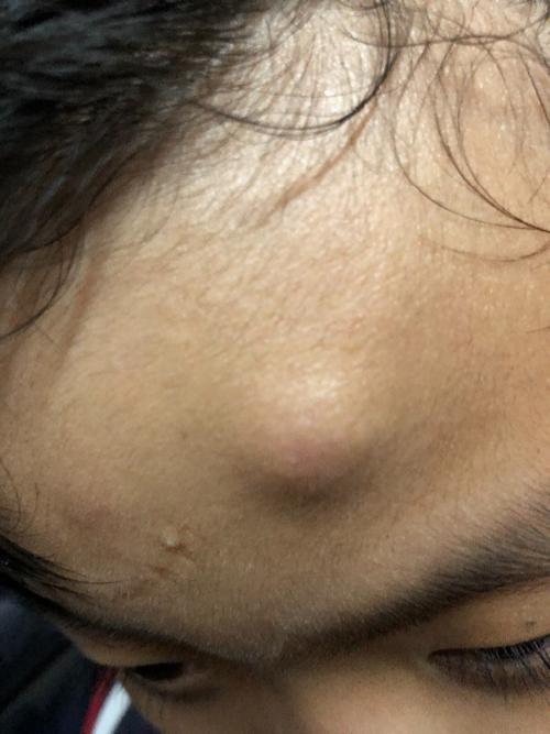 小孩额头长一个包是什么怎么治疗 将近快一个月了 摸起来硬硬的不痛